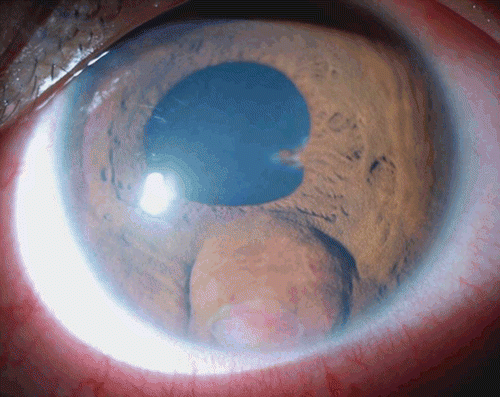 FIGURE 1  Slit lamp photo shows an iris bulge inferior to the pupil, with an area of iris atrophy showing a white vascularized mass underneath. There is papillary posterior synechia at 3 o’clock meridian.