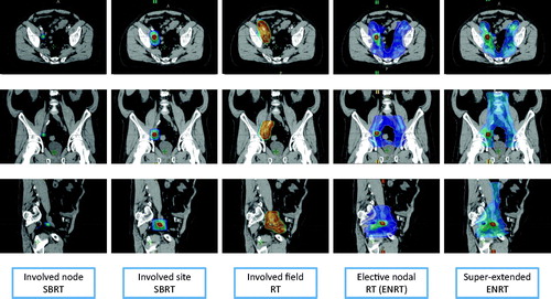Figure 1. Color wash representation (95% of the prescribed dose) of the different radiotherapy treatment strategies for nodal oligorecurrent prostate cancer patients. Involved node SBRT, 30 Gy in 3 fractions; Involved site SBRT, 24 Gy in 3 fractions with a simultaneous integrated boost (SIB) at 30 Gy; Involved field RT, 50.4 Gy in 28 fractions; ENRT, 45 Gy in 25 fractions with SIB of 65 Gy on PET-positive nodes; Super-extended ENRT: 45 Gy in 25 fractions with SIB of 65 Gy on PET-positive node.