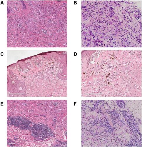 Figure 2 (A) Massive neoplasm cells with hyperchromatic nuclei, infiltrating through the tissue with associated thickening of interweaved collagen fibers (hematoxylin and eosin, original magnification ×100). (B) Neoplastic cells exhibited mild to moderate atypia. Cell morphology varied. They feathered either long or short spindles, accompanied with hyperchromatic nuclei, vesicular shape, increased nucleoplasm ratio, and sometimes mitotic figures (hematoxylin and eosin, original magnification ×400). (C) Melanocytes at the dermo-epidermal junction were arranged in a nesting or linear manner, similar to malignant freckles. Some of the melanocytes exhibited moderate atypia (hematoxylin and eosin, original magnification ×100). (D) Melanin deposition was prominent in the cytoplasm of neoplasm cells (hematoxylin and eosin, original magnification ×100). (E) Neurophilicity manifested by one or more well-defined spindle cell foci around the nerve or within the nerve sheath, squeezing the nerve sheath (hematoxylin and eosin, original magnification ×200). (F) Patchy lymphocytic infiltrates around and below the lesions, some of which formed lymphoid follicular-like structures (hematoxylin and eosin, original magnification ×100).