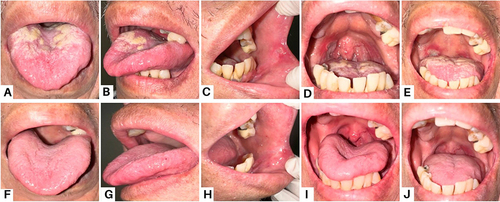 Figure 3 Clinical presentation of the patient Case 3 (A and B) On the first visit, the thrush was present as yellowish-white plaques on the tongue (C) A single ulcer on the buccal mucosa (D and E) A painful, primary, single ulcer on the oropharynx (F–J) The lesions had entirely resolved after four weeks.