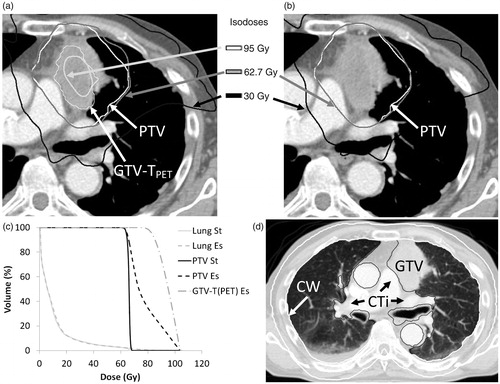 Figure 1. A NARLAL2-escalated plan (a) and a standard plan (b). PTV is shown for both (a) and (b), whereas GTV-TPET is only shown for the escalated plan. Comparison of the DVH parameters (c) shows that MLD remains virtually unchanged (MLDstandard =10.1 Gy and MLDescalated =10.4 Gy). Panel (d) illustrates the delineation of chest wall (CW, white) and connective tissue (CTi, black). The CTi includes all mediastinal tissue not otherwise defined as OAR or GTV. In the present image, the OAR were aorta, bronchi and oesophagus.