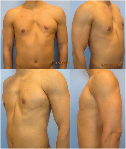 Figure 3. Post-operative result at 18-month follow-up, in the frontal (upper left), right oblique (upper right), left oblique (lower left), and lateral (lower right).