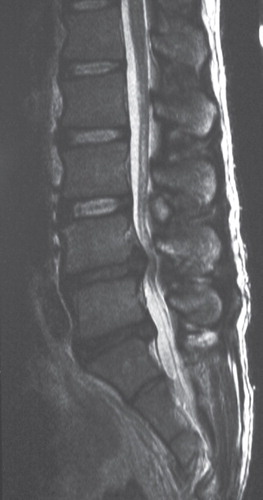 Figure 3. MR images of the lumbar spine revealed spinal canal stenosis at L4/5 (T2-weighted image, sagittal section).