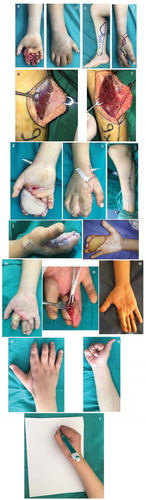 Figure 6. Case 1. a: Palmer surface of right hand showing soft tissue defect. b: Dorsal surface of right hand showing soft tissue defect. c: Flap marking. d: Anastomosis site. e: Dissection of the perforator. f: Dissection of the pedicel. g: Flap in-setting Palmer surface. h: Flap in-setting dorsal surface. i: Donor side closure. j: Patient after 1 week. k: Patient after 1 month. l: Patient after 3 months. m: Patient after separation of index finger. n: Patient during separation of middle and ring fingers showing the perforator. o: Patient after 6 months. p: Patient after 6 months. q: Patient after 6 months. r: Patient after 8 months