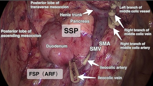 Figure 1 Surgical planes in laparoscopic CME for ascending colon cancer.Abbreviations: ARF, anterior renal fascial plane; FSP, first surgical plane; SMA, superior mesenteric artery; SMV, superior mesenteric vein; SSP, second surgical plane; CME, complete mesocolic excision.