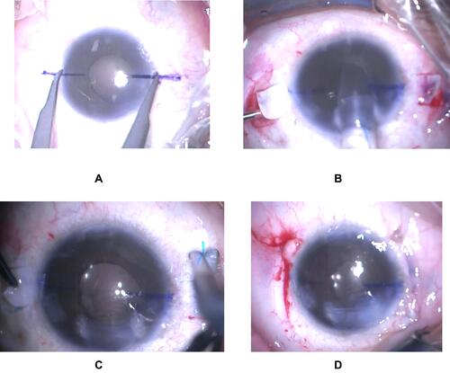 Figure 2 (A) scleral fixation using fibrin glue, (B) introducing IOL into the sulcus and externalizing the haptics through the flap, (C) haptics trimming, (D) scleral flaps and conjunctiva closed using fibrin glue.