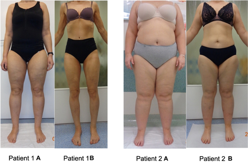 Figure 2 Lower limb photos of two patients (no. 1 and no. 2) with lipedema before and after the LCHF diet. Patient 1 and 2: (A) - photo before intervention; (B) - photo after intervention (own documentation).