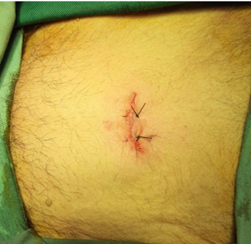 Figure 3 Patient with postoperative small suprapubic incision.