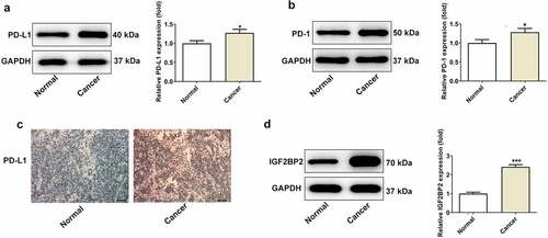 Figure 1. The expression of PD-L1, PD-1 and IGF2BP2 in pyriform sinus of healthy individuals and patients with hypopharyngeal carcinoma. The protein expression of PD-L1 (a) and PD-1 (b). (c) The immumohistochemical staining for PD-L1 (scale bar, 40 μm). (d) The protein expression of IGF2BP2 in normal and cancer tissues. *P < 0.05 and ***P < 0.001 vs normal group