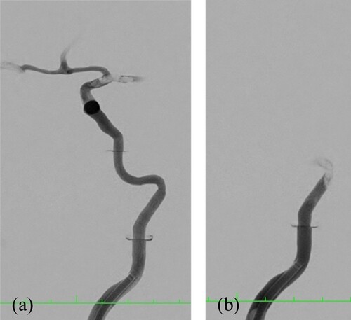 Figure 15. Visualization by angiography and contrast medium. Occlusion of the A. cerebri media by a stamped test body of 2% agarose (a) and occlusion of the skull base by a stamped test body of 5% agarose (b).