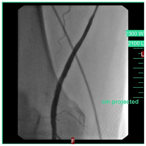 Figure 6 Normal flow in the bypass following stent percutaneous transluminal angioplasty.