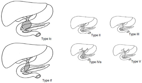 Figure 3 Todani classification of choledochal cysts.