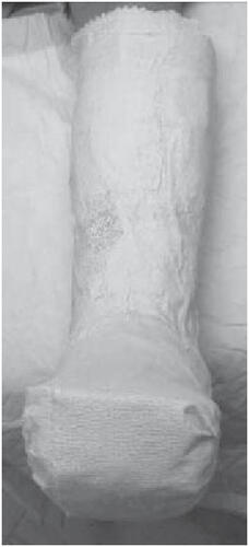 Figure 7c Instant total contact cast: made by wrapping the removable cast walker with a layer of plaster of paris.