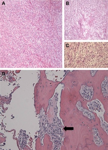 Figure 4 H&E microphotographs at (A and B) 4× and (C) 10× magnification, demonstrating moderately differentiated spindle cells with almost no mitoses. The hyperchromatic cells, which have coarse chromatin with mild pleomorphism, are arranged in short fascicles that split and merge, giving the classical herringbone architecture of fibrosarcoma. (D) Malignant spindle cells are seen in a fascicular pattern invading adjacent inferior orbital rim bone (black arrow).