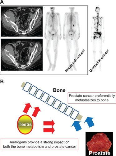 Figure 2 Characteristics of urological cancer skeletal lesions. Characteristics of bone metastasis from renal cell cancer. The bulky bone metastatic lesion, which was demonstrated by abdominal CT-scan, has a negative appearance by bone scan. Typical bone metastatic lesions from urothelial cancer, which have a positive appearance by bone scan, are shown on the right side (A). Schematic representation of the interplay between prostate cancer, bone and testosterone (B).