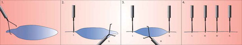 Figure 3. Approximating the peripheral wound edges prior to Zipper closure. Larger or round lesions, where the edges are further apart, can benefit from placing a clip in two opposite peripheries of the wound surface, making it more almond-shaped. After doing this, clipping can be continued between the clips in a zipper fashion.