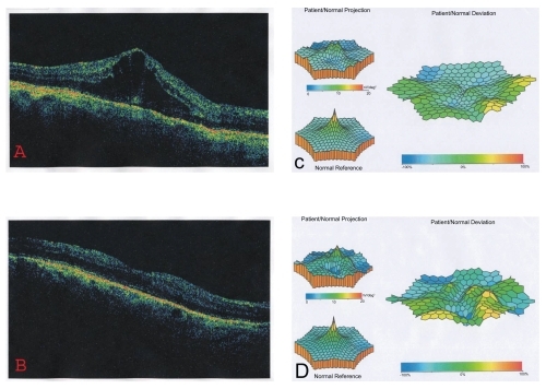Figure 1 A 58-year-old man with pseudophakic CME. The pretreatment OCT shows an increase of the central retinal thickness (A), and the mf-ERG reveals a craterlike depression of the foveal and perifoveal area (B). Twelve months after treatment the OCT depicts the improvement of the central retinal thickness (C) and the mf-ERG shows a real recovery of the electrical activity of the foveal (area 1) and parafoveal (area 2) area (D).