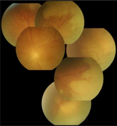 Figure 1 Montage photo of initial presentation with large confluent areas of retinal necrosis.