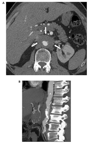 Figure 1 CT angiography of the aorta performed with 64-row MDCT. (A) Axial image at the level of the renal arteries showing narrowing of the aortic lumen, aortic wall thickening and periaortic rind (arrows). (B) Multiplanar reformat image showing periaortic thickening confined to the abdominal aorta (A) (dashed line). The thoracic aorta is spared. Numerous calcified plaques are seen mainly in the infrarenal segment of the abdominal aorta.