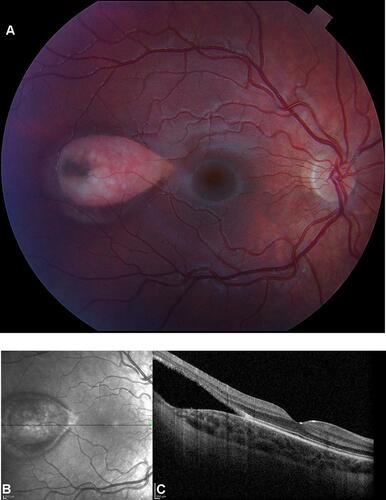 Figure 7 Color fundus photograph (A) near infrared reflectance image (B), and SD-OCT image (C) of an 8-year-old girl with torpedo maculopathy of the right eye. Her visual acuity was 20/20 bilaterally. The fovea is spared. The point of the torpedo lesion is closest to the fovea. The lesion would be classified as type 2 because of the cavitation (green arrow) of the outer retina. The outer nuclear layer over the cavitation (pink arrow) is attenuated. The choroid is attenuated, but the scleral-choroidal interface is not affected (yellow arrows). The retinal pigment epithelium at the base of the outer retinal cavity is hypopigmented in the color fundus photograph and hyporeflective in the OCT image.