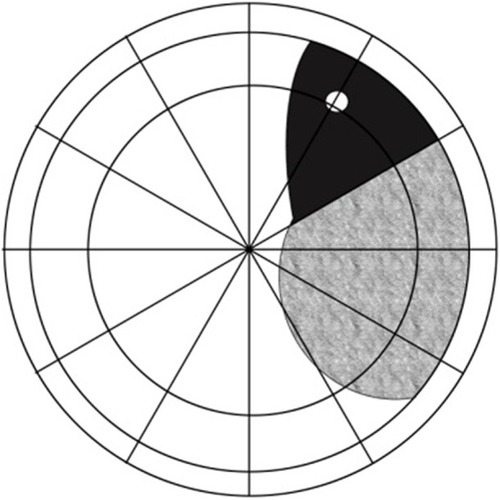 Figure 2 Superior temporal or nasal detachments that did not exceed the inferior vertical midline.