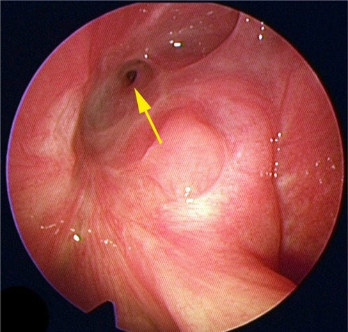 Figure 7 Postoperative transnasal endoscopic examination.