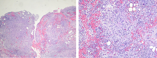 Figure 3 Histopathologic results showed infectious granuloma with lymphocytes, plasma cells, multinucleate giant cells infiltrate in the surrounding tissues and heavy lymphocytes, plasma cells, neutrophils infiltrate in deep dermis (H&E stain, Original magnification×10; Original magnification ×40).