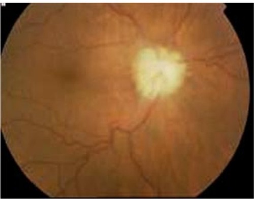 Figure 5 Fundus photograph of the right eye of a patient with Adamantiades–Behçet disease, showing optic nerve involvement.