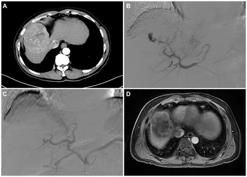 Figure 1 Image of VL and its management in a 52-year-old male patient. Arterial phase in the CT was significantly enhanced, and the middle hepatic vein and inferior vena cava were invaded by tumor (A). In the first DEB-TACE, CalliSpheres® Beads with a diameter of 100–300 μm loaded with 15 mg of arsenic trioxide were used to embolize the right hepatic artery, and the VL phenomenon occurred in the re-examined angiography (B). PVA particles with a diameter of 350–560 μm were subsequently added for embolization until the VL phenomenon disappeared in the re-examined angiography (C). MRI at 4 weeks after first DEB-TACE revealed partial contrast enhancement in the peripheral of intrahepatic lesion, suggesting a partial response according to the mRECIST criteria (D).