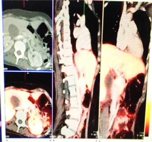 Figure 1: Ga-DOTA octreotate PET/CT showing avid active disease in the uncinated process of the pancreas.