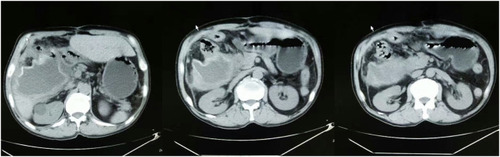Figure 6 Cystic echinococcosis—postoperative recurrence, rupture, combined with infection.