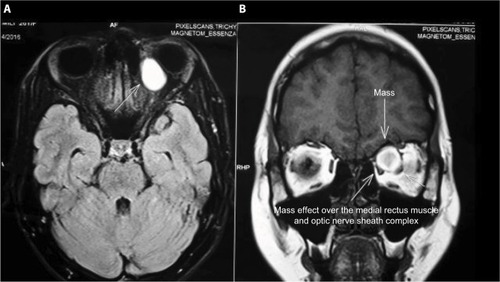 Figure 4 Magnetic resonance imaging of axial (A) and coronal (B) section.