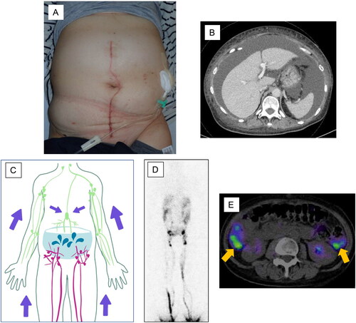 Figure 1. Preoperative findings. Abdominal distension is observed (A). Contrast-enhanced CT shows a large amount of ascites (B). The schema indicates that the lymphadenectomy resulted in a large amount of lymphatic fluid leakage and ascites accumulation (C). Lymphoscintigraphy or SPECT reveals leakage of the radioisotope into the peritoneal cavity. No secondary lymphedema is observed in either lower extremity (D). The arrow points to the leaked radioisotope (E).