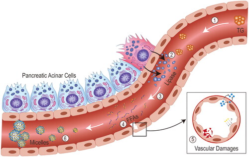 Figure 3. Mechanism of action of free fatty acids. ① excess triglycerides reach the vascular bed of the pancreas with blood transport in the form of triglyceride-rich lipoproteins. ② for idiopathic reasons, large amounts of lipase from pancreatic acinar cells are released into the blood through the vascular endothelium. ③ triglycerides are broken down by lipase into fatty acids and glycerol. ④ free fatty acids (FFAs) that exceed the albumin-binding capacity act directly on the vascular endothelium, ⑤ causing vascular damage such as endothelial dysregulation, vascular leakage and coagulation activation. ⑥ high concentrations of FFAs gradually aggregate into micelles with detergent like properties, causing ischaemia and subsequently triggering acidosis, trypsin activation, etc.