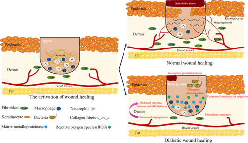 Figure 1 The physiological process of normal wound and diabetic wound. Unlike normal wounds, diabetic wounds are characterized by impaired angiogenesis, excessive inflammatory macrophages. Excessive production of matrix metalloproteinases (MMPs) at the wound site, and hyperglycemia leads to an increase ROS that prevent the formation of healthy tissue.