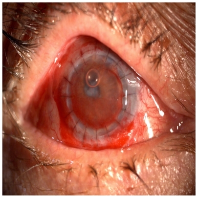 Figure 2 Outcome of the penetrating keratoplasty in a patient with corneal ulcer.