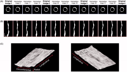 Figure 6. Intermediary IVUS image generation and volumetric 3 D IVUS visualization of the unfolded curved iliofemoral artery (r: radial, θ: circumferential).