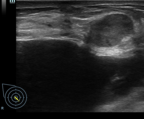 Figure 1 cPMBC, 34 years old, female. The patient was found to have a right breast lump after prosthetic implantation surgery. The size is 17×14mm, the shape is regular, the edges are smooth, and there is no blood flow signal inside. It was misdiagnosed as fibroadenoma, and the ultrasound BI-RADS category is 3. A “halo sign” can be seen around the lesion. The pathological diagnosis is pure mucinous carcinoma.