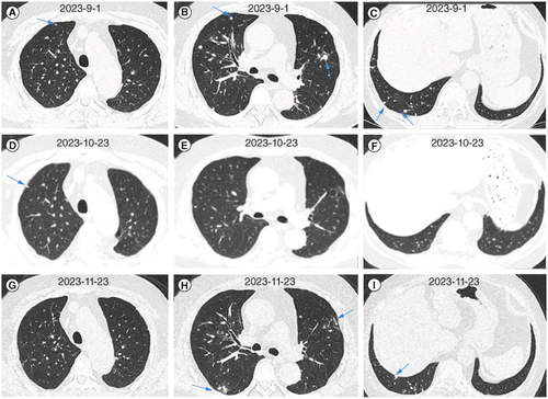 Figure 5. Changes in chest computed tomography images of the patient treated with antifungal therapy between 4 and 6 months. (A–C) Chest CT images after 4 months of antifungal treatment. (D–F) Chest CT images after 5 months of antifungal treatment. (G–I) Chest CT images after 6 months of antifungal treatment.CT: Computed tomography.