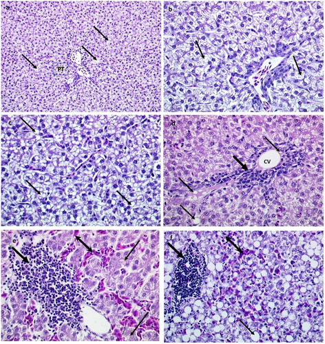 Figure 4. Histological sections of livers from hens in the control group and hens treated with oestradiol. Images (a and b) show normal structure of the tissue with some fat deposition (thin arrows) in hepatocytes, and small fat vacuoles around the nucleus (microvesicular fatty change) PT=portal triad; H&E stain, using ×200 (a) and ×400 (b) magnification; portal triad = PT. Images (c and d) present livers from treated hens (after week 1), while images (e and f) show livers of oestradiol- treated hens (after week 2); CV=central vein. Thin arrows show fat vacuoles in hepatocytes and fat droplets in the enlarged sinusoid; nucleus disappeared or displaced to periphery in hepatocytes (macrovesicular steatosis). Note focal infiltration with leukocytes (thick arrow) near central vein (CV); and erythrocytes (double-headed arrow). H&E stain, using ×400 magnification.