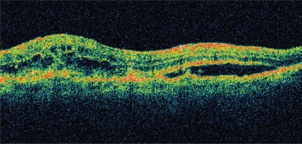 Figure11a OCT of neovascular AMD pre-ranibizumab treatment, visual acuity 20/100. Note intra- and sub-retinal fluid and macular thickening.