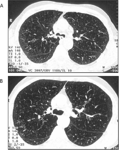 Figure 1 High-resolution computed tomography (HRCT) scans at the carina level, out of the 3 selected lung levels, spirometrically gated: (A) at 10% of vital capacity, (B) at 90% of vital capacity.