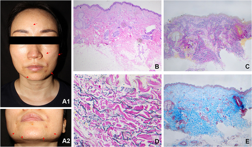 Figure 1 Multiple, skin-colored papules on face (The red arrows mark several of these typical papules). Near the left corner of the mouth, there are 2 red follicular papules (diagnosed as acne) (A1 and A2). Normal epidermis with slight fibrosis in the dermis (B) (H&E, 40×). Patchy loss of elastic fibers throughout the dermis with no correlation to hair follicles (C) (Verhoeff-Van Gieson, 40×). Prominent elastic fragmentation (D) (Verhoeff-Van Gieson, 400×). Focal hyperplasia of collagen bundles in the mid-dermis (E) (Masson staining, 40×).