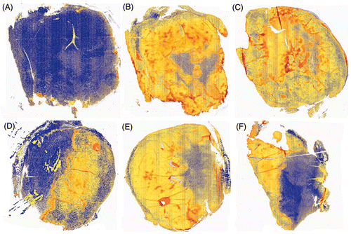 Figure 3. Pseudocolour images of representative tumours showing three levels of pimonidazole staining. Pimonidazole stained sections were scanned and analysed using an Aperio ImageScope. A colour deconvolution algorithm converted brown pimonidazole staining into red, orange and yellow pseudocolours corresponding to high, medium and weak intensities of pixels. Blue colour denotes lack of positive pixels. The negative control (without primary antibody) is mostly blue (A). Examples of control tumours are shown in panels B and C. Examples of tumour remaining after ablation are shown in panels D, E and F.