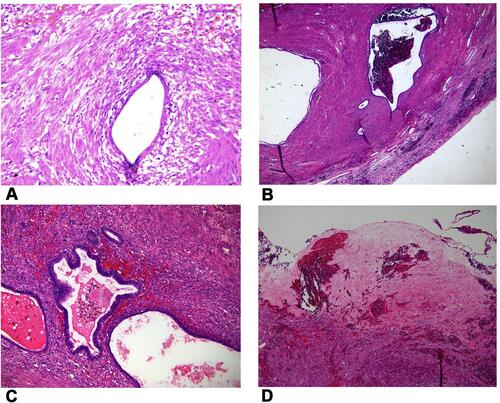 Figure 4 Histology slides from the specimen confirming the diagnosis of benign adenomyoma. (A) Endometrial glands and macrophages. (B) Endometrial glands and smooth muscle. (C) Endometrial glands with no atypia. (D) Areas of hyalinisation.