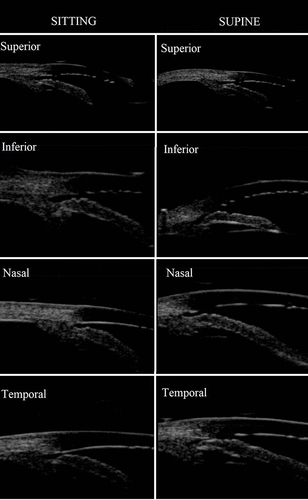 Figure 2 Comparison between angle configurations of four quadrants in sitting and supine positions. All parameters of angle morphology in the superior, inferior, nasal, and temporal quadrants of the same patient were slightly greater in the sitting position than in the supine position. In particular, the temporal peripheral iris was close to the functional trabecular meshwork (iridotrabecular contact) in the supine position, whereas angles were open in the sitting position.