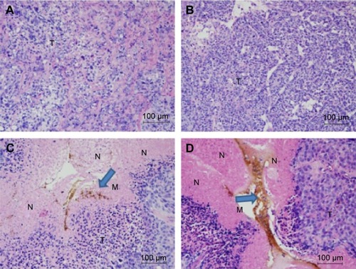 Figure 8 Histological changes in xenograft tumors (H & E).Notes: Sections from the blank control (A); gene transfection-alone group (B); thermotherapy-alone group (C); and combined therapy group (D) are shown. Histological examination revealed that the necrotic areas in C and D were much larger than the intrinsic necrosis of the tumor shown in A and B. The blue arrows indicate the magnetic nanoparticles. Magnification ×200.Abbreviations: H & E, hematoxylin and eosin; M, materials of Mn0.5Zn0.5Fe2O4 nanoparticles; N, necrosis; T, tumor tissue.