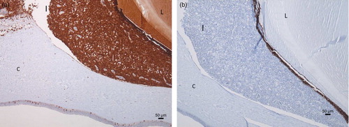 Figure 4. Immunohistochemistry of the female's eye shows a T-lymphocyte infiltration in the iris (I) (CD-3 immunohistochemistry) (a) and absence of B-lymphocyte infiltration (CD-20 immunohistochemistry) (b) (C: Cornea; L: lens).