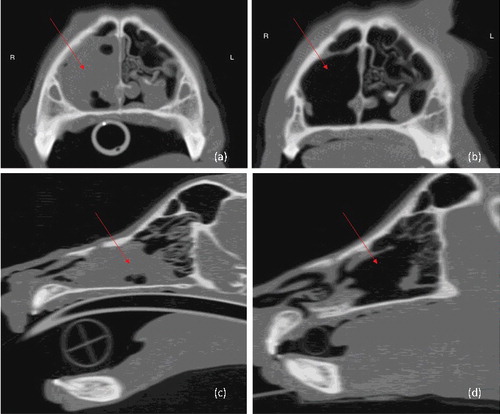 Figure 1. Pre-treatment and post-treatment CT images of case 1: (a) pre-treatment transverse; (b) post-treatment transverse; (c) pre-treatment longitudinal; (d) post-treatment longitudinal. Arrows mark the location of the tumour.