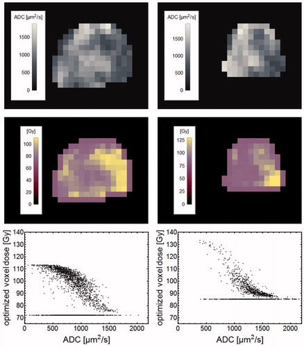 Figure 6. The left column show data for the test set patient with the highest TCP increase (30%), while the right column show data for the patient with the lowest TCP increase (4%). For respective patient, uppermost panels show ADC images of a central section through the prostate with the corresponding dose painting prescriptions shown in the middle row. The lowermost row shows optimized voxel doses vs. ADC for the CTVT voxels. ADC voxels with the minimum dose represent solitary voxels treated as noise through the erosion operation.